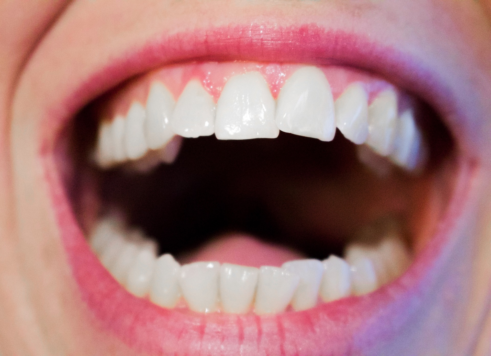 Teeth whitening - Mississauga Dentist - Bristol Dental